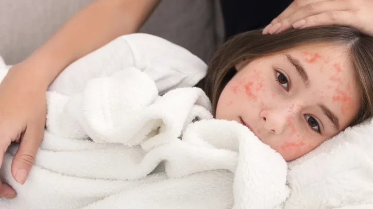 sarampo em alta em 2025