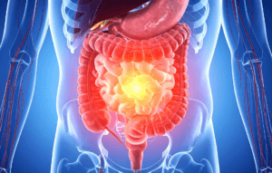 intestino não saudavel